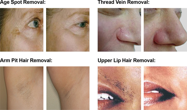 Laser-Treatment-images